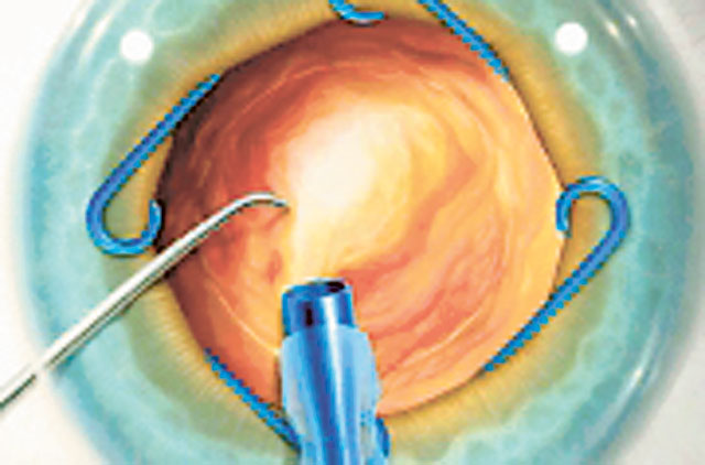 New device makes cataract removal easier