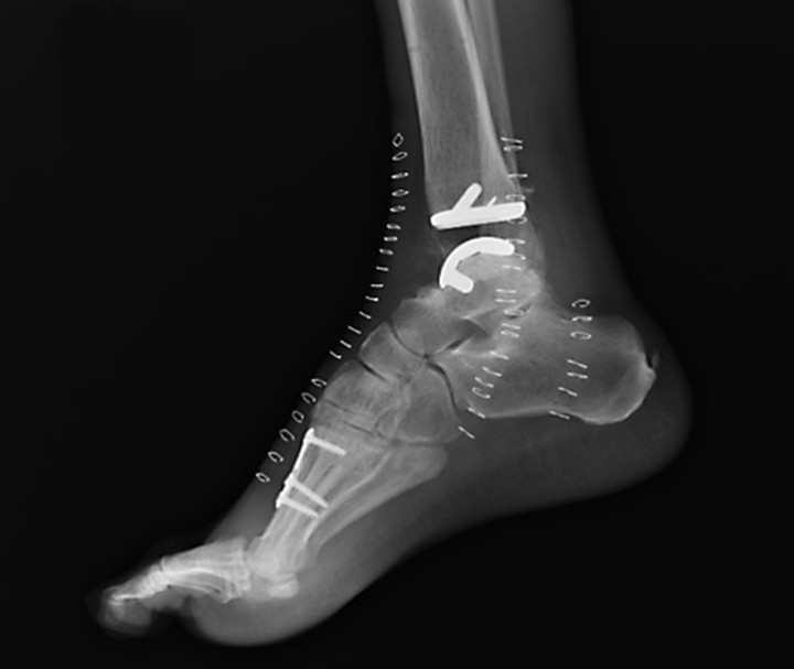 Ankle replacement surgery gains acceptance